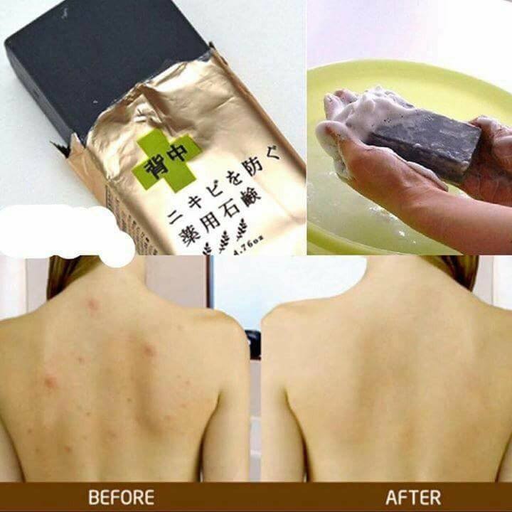 Xà Phòng Trị Mụn Lưng - For Back Medicated Soap Pelican của Nhật    — ảnh chính