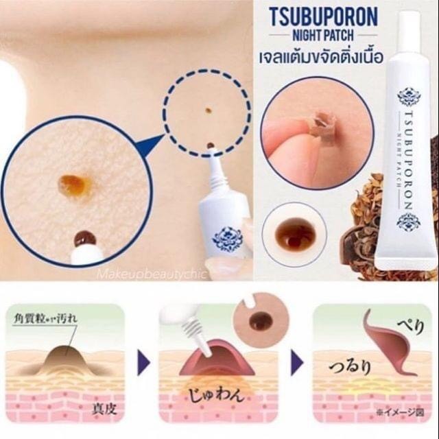 Kem trị mụn thịt Tsubuporon vùng cổ / cơ thể  — ảnh 2